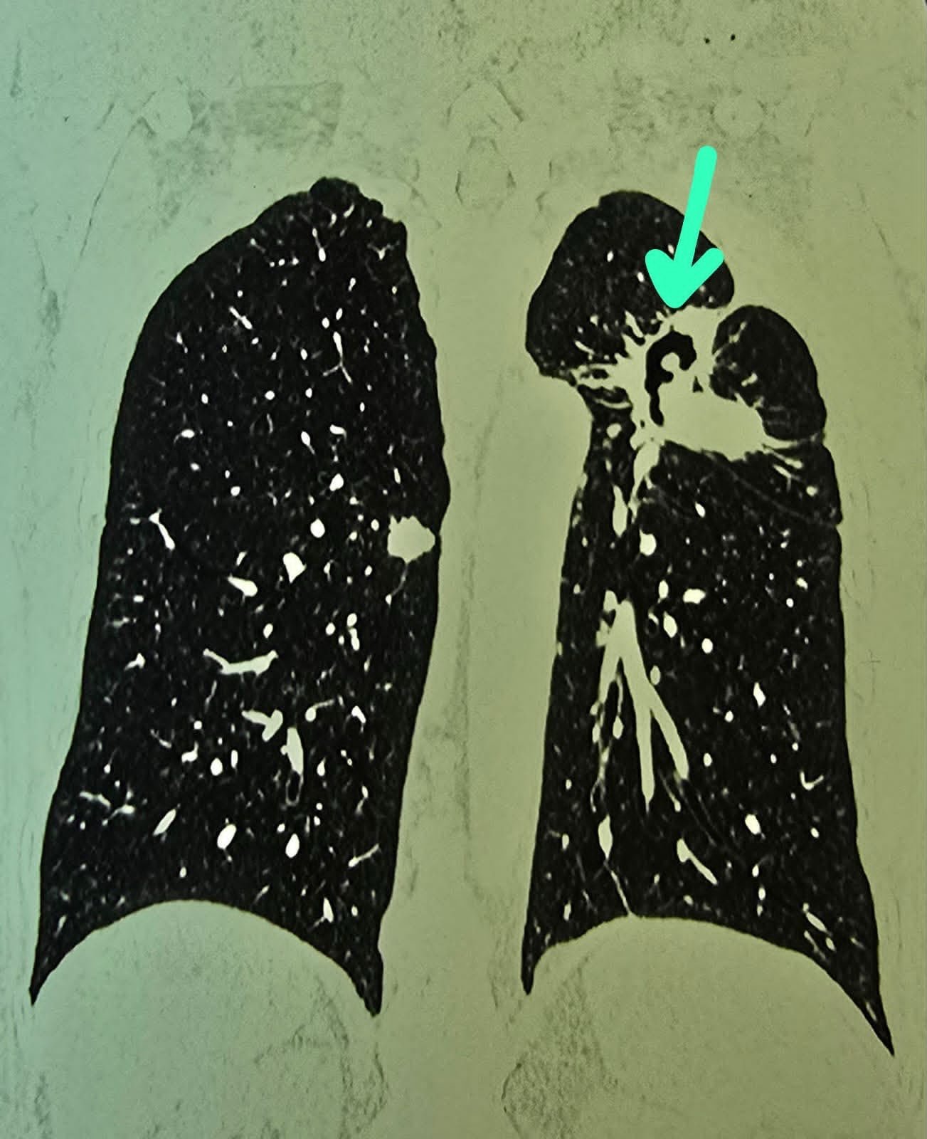 Ambedkar Hospital Sets New Benchmark with 13 Lung Lobectomies in Two Months