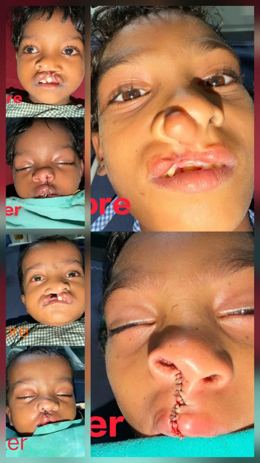 चिरायु योजना से जन्मजात समस्या से मिली राहत, तीन बच्चों के चेहरों पर लौटी मुस्कान